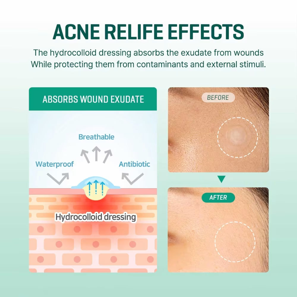 SOME BY MI - 30 Days Miracle Clear Spot Patch